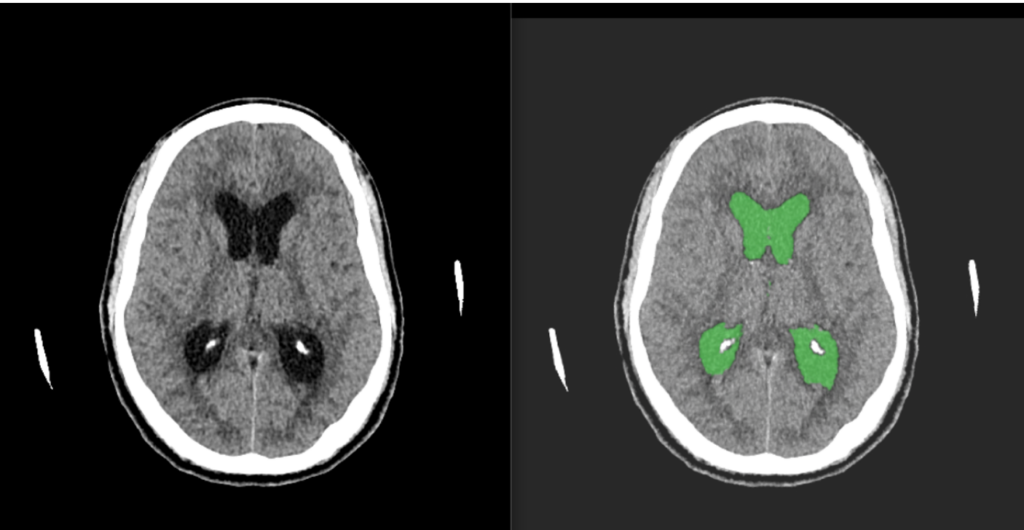Cortechs.ai | Enhancing Neuroimaging Insights: LVV & ICV Quantification and Midline Shift Indexing with NeuroAlign CT